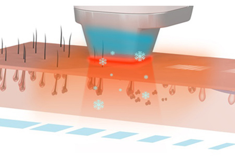 laser treatment for hair removal.jpg